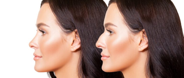 IS GETTING A RHINOPLASTY SURGERY WORTH IT? IS GETTING A RHINOPLASTY SURGERY WORTH IT?